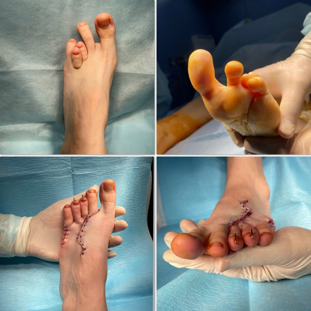 Лечение брахиметатарзии_2.jpg