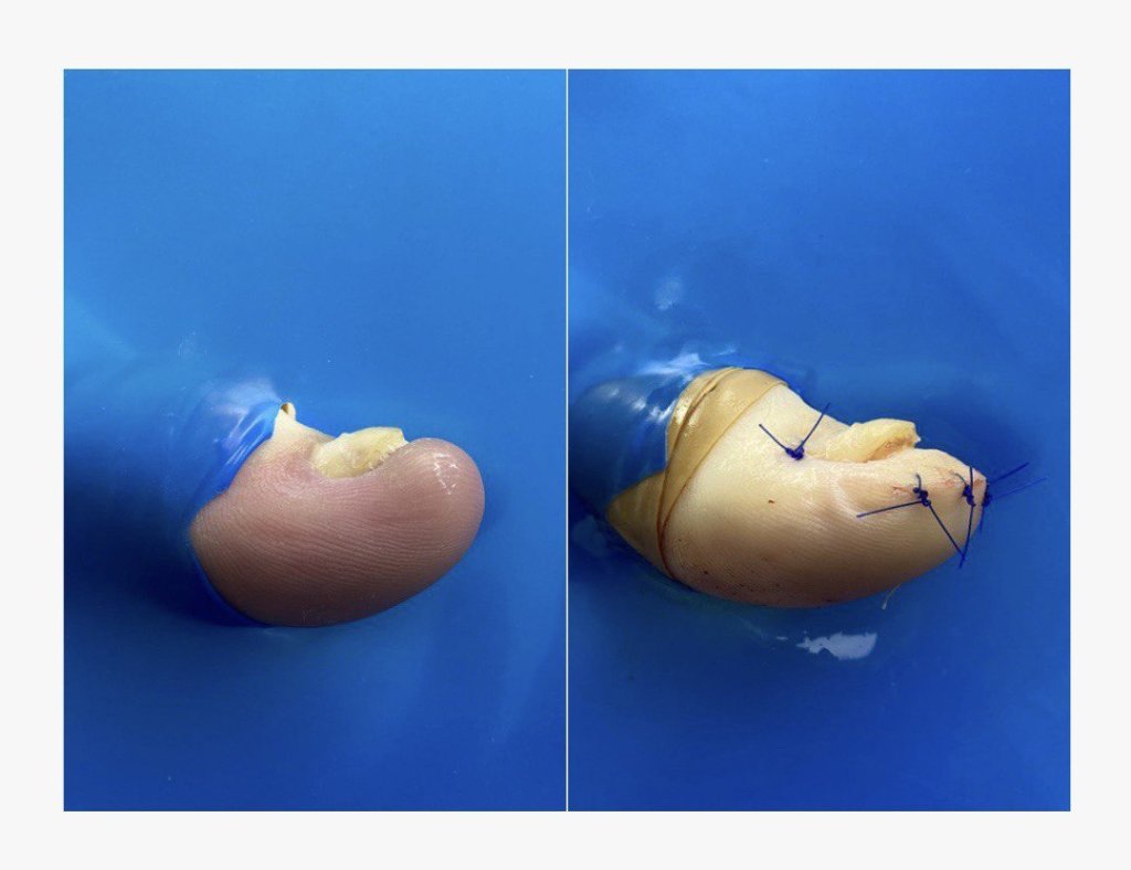 Удаление подногтевого экзостоза.jpg