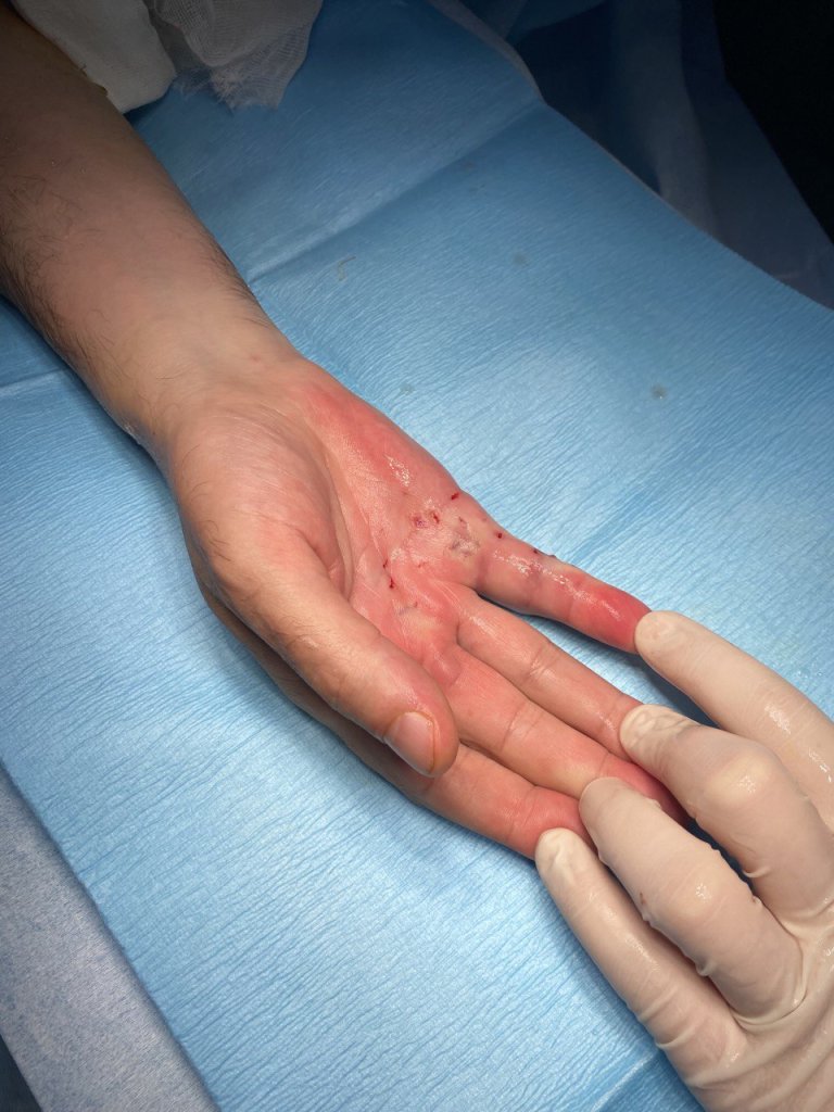 Иссечение контрактуры_2.jpg