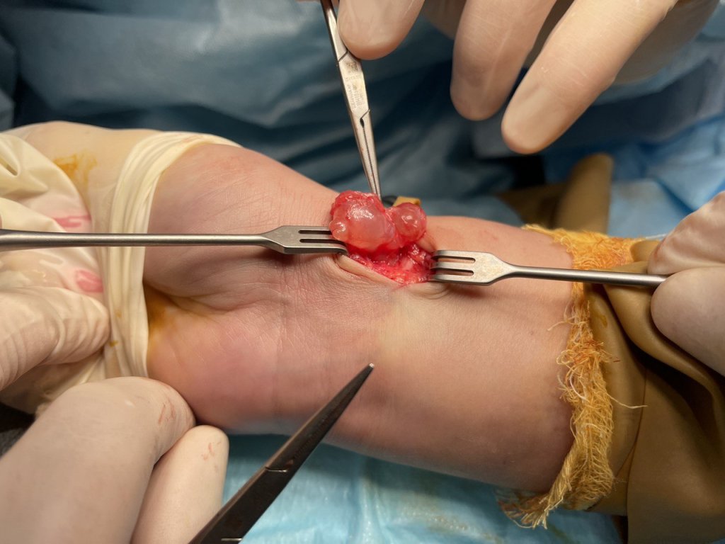 Удаление гигромы_3.jpg