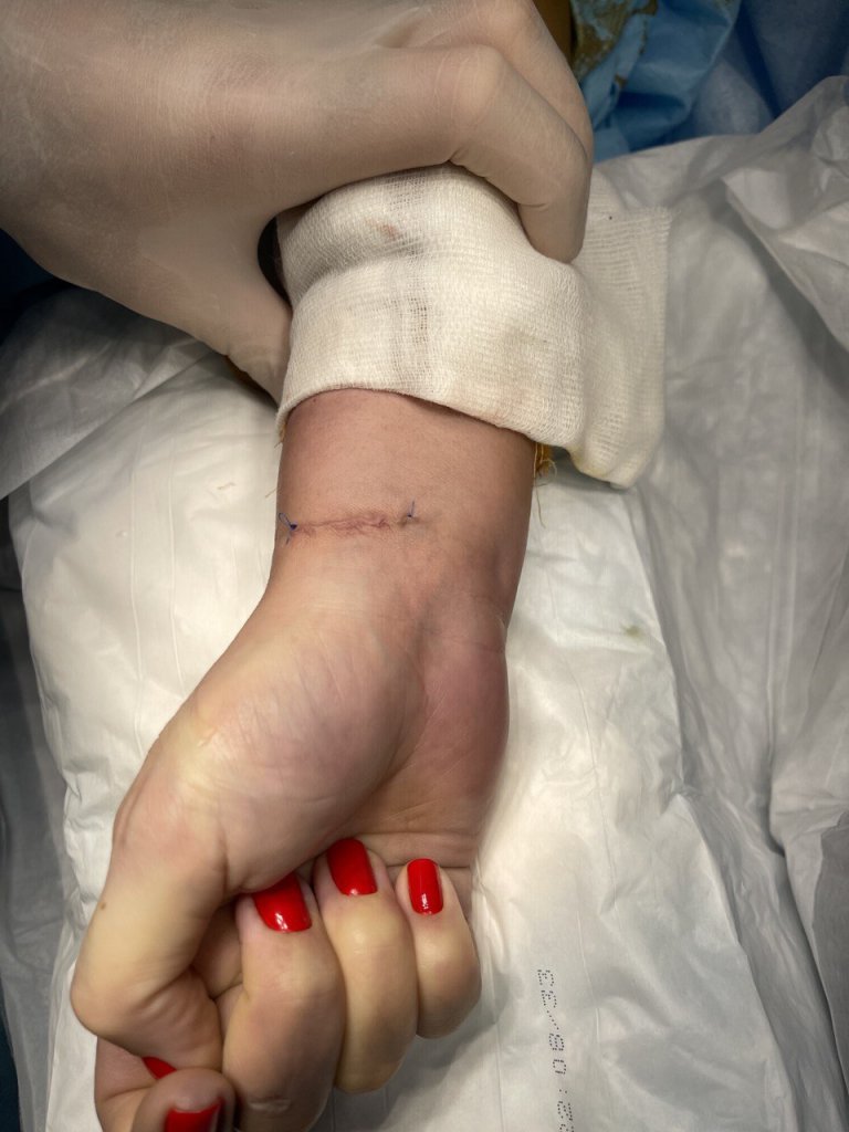 Удаление гигромы_2.jpg